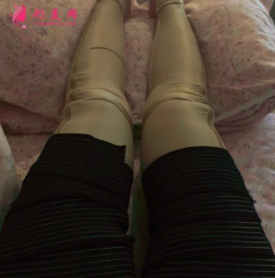 廈門安黛美醫(yī)療整形美容大腿吸脂案例