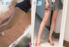 上海華美整形美容做的大腿吸脂，我也擁有纖纖細腿啦