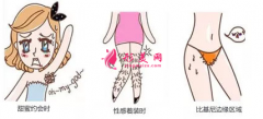 激光脫毛后要注意什么？