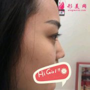 上海伯思立醫(yī)療美容假體隆鼻案例 大家都夸我鼻型好精致自然