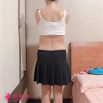 重慶腰腹吸脂術(shù)后效果分享，讓你瞬間擁有小蠻腰~