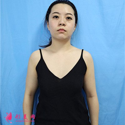 重慶小仙女自體脂肪隆胸恢復(fù)效果反饋