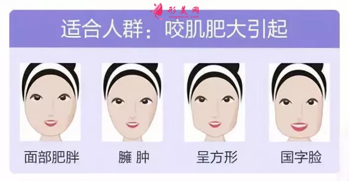 打瘦臉針多少天可以看到效果