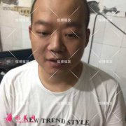 在成都恒博植發(fā)醫(yī)院做種植頭發(fā)，終于告別了“地中?！?></a><p class=