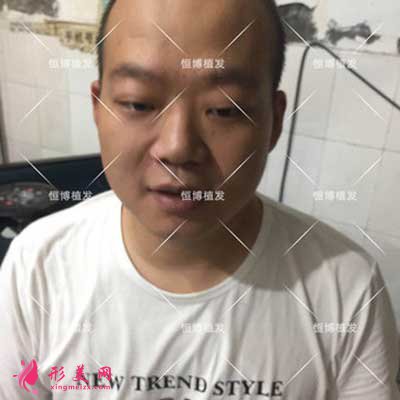 植發(fā)術前圖片