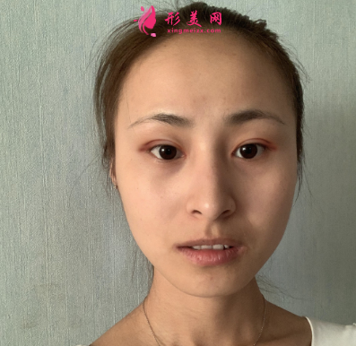 云想月醫(yī)療美容醫(yī)院雙眼皮術(shù)后7天