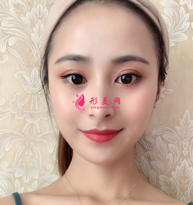 術(shù)后33天雙眼皮效果圖片