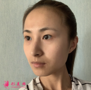 成都美容整形醫(yī)院雙眼皮案例 術(shù)后70天效果對(duì)比圖分享