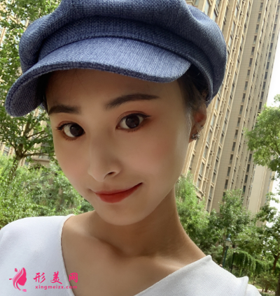 雙眼皮整形手術(shù)術(shù)后53天