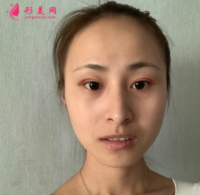 云想月醫(yī)療美容醫(yī)院雙眼皮術(shù)后7天