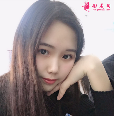 隆鼻+雙眼皮整形案例分享 術(shù)后80天效果對比圖