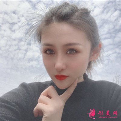 昆明小姐姐眼部綜合術(shù)后恢復(fù)效果反饋