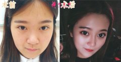 鄭州附二院做的鼻部多項(xiàng)，術(shù)后4個(gè)月真人案例分享
