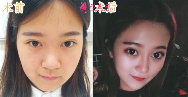 鄭州締萊美醫(yī)療美容醫(yī)院鼻部多項案例