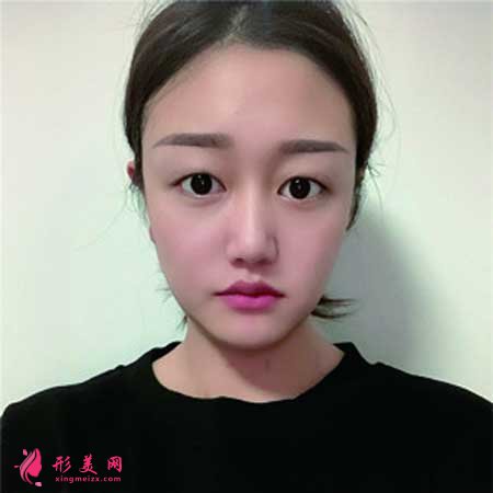 華美紫馨陳楊做雙眼皮案例分享,附帶價格表