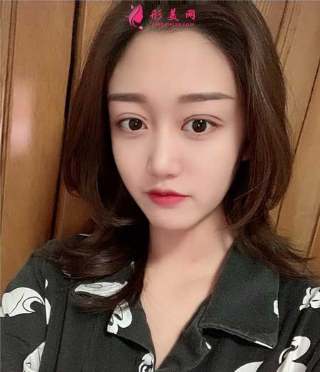 華美紫馨陳楊做雙眼皮案例分享華美紫馨陳楊做雙眼皮案例分享,附帶價格表