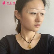 昆明市第一人民醫(yī)院小姐姐眼部綜合術后恢復效果反饋
