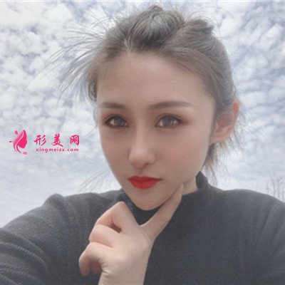 昆明小姐姐眼部綜合術(shù)后恢復(fù)效果反饋