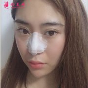 上海華美整形醫(yī)院鼻綜合手術術后恢復情況對比