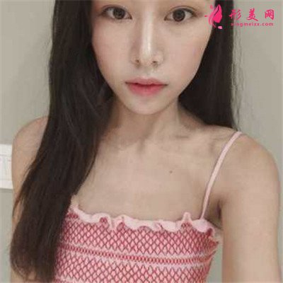 重慶假體隆胸術(shù)后恢復(fù)效果對比