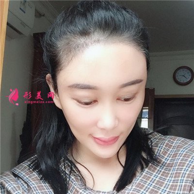 上海種植發(fā)際線術(shù)后恢復(fù)效果反饋 術(shù)后 上海種植發(fā)際線術(shù)后恢復(fù)效果反饋
