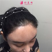 上海華美醫(yī)療美容醫(yī)院種植發(fā)際線術(shù)后恢復(fù)效果反饋
