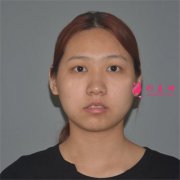上海華美醫(yī)療美容醫(yī)院小姐姐吸脂瘦臉術后恢復效果分享
