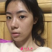 南京華美美容醫(yī)院鼻綜合手術術后恢復情況對比圖分享