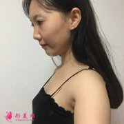 武漢假體隆胸領(lǐng)哪里好？小姐姐術(shù)后恢復(fù)效果展示