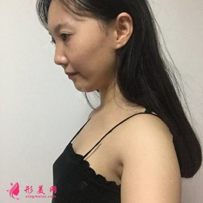 武漢假體隆胸術(shù)后恢復(fù)效果展示