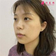上海伯思立醫(yī)療美容切開(kāi)雙眼皮手術(shù)術(shù)后效果反饋