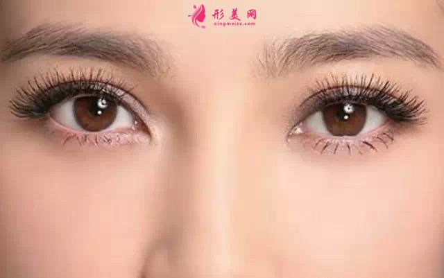 埋線雙眼皮的價格是多少