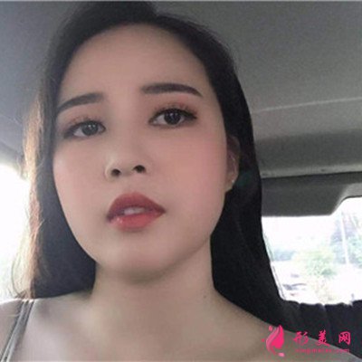 上海眼部綜合手術術后效果分享