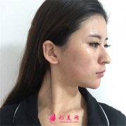成都軍大面部填充手術術后恢復情況對比