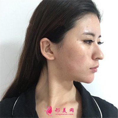 成都面部填充手術(shù)術(shù)后恢復(fù)情況對(duì)比
