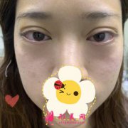 成都趙博士整形醫(yī)院激光祛眼袋恢復(fù)順利 不留痕跡 活力十足