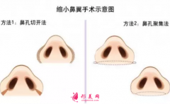 鼻翼縮小手術(shù)的價格費用是多少?