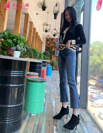 去上海華美找張麗麗做大腿吸脂手術后30天