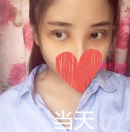 南方醫(yī)院胡志奇雙眼皮案例欣賞