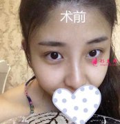 南方整形美容醫(yī)院胡志奇做雙眼皮真人案例欣賞