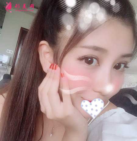 南方醫(yī)院胡志奇雙眼皮案例欣賞