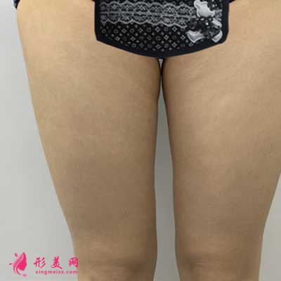在成都米蘭柏羽整容醫(yī)院大腿抽脂手術(shù)前