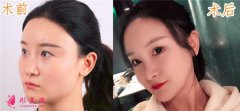在上海華美醫(yī)療美容醫(yī)院做的V-LINE瓜子臉手術(shù)案例分享