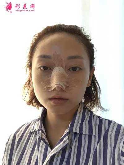 軍建--鼻綜合術(shù)后3天圖片