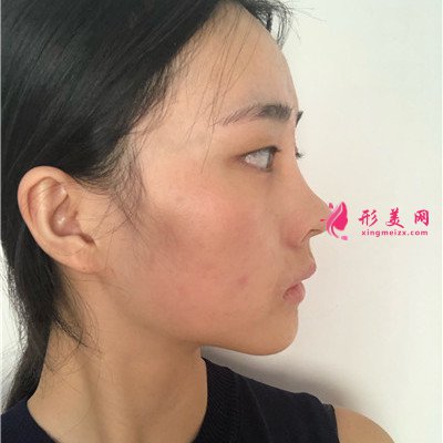 重慶面部線雕術(shù)后恢復(fù)情況對比