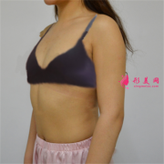 成都圣丹福整形美容醫(yī)院假體隆胸術(shù)后恢復(fù)情況對(duì)比