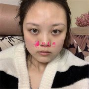 上海九院眼部綜合術(shù)后恢復(fù)效果反饋