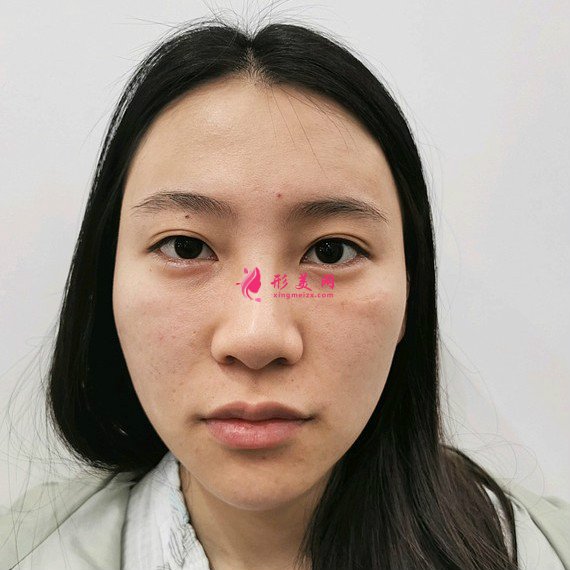 整形前后對(duì)比圖片