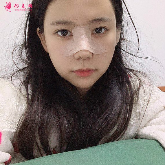 立場(chǎng)簡(jiǎn)單的整形術(shù)后圖片