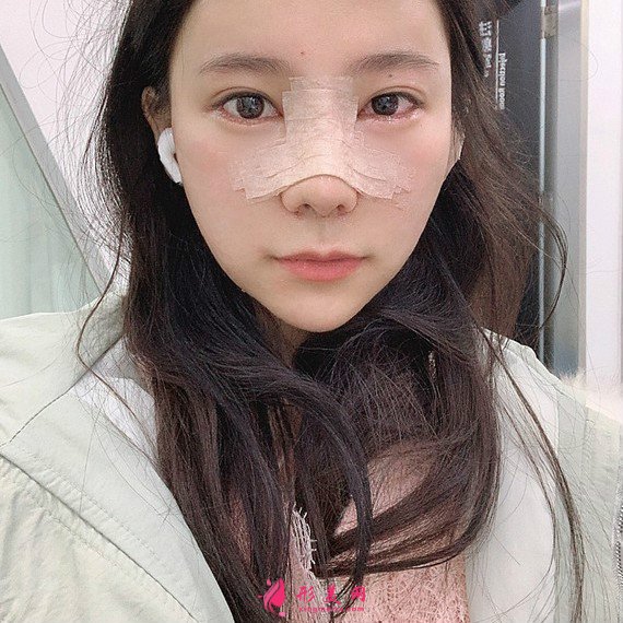 立場(chǎng)簡(jiǎn)單的整形術(shù)后圖片